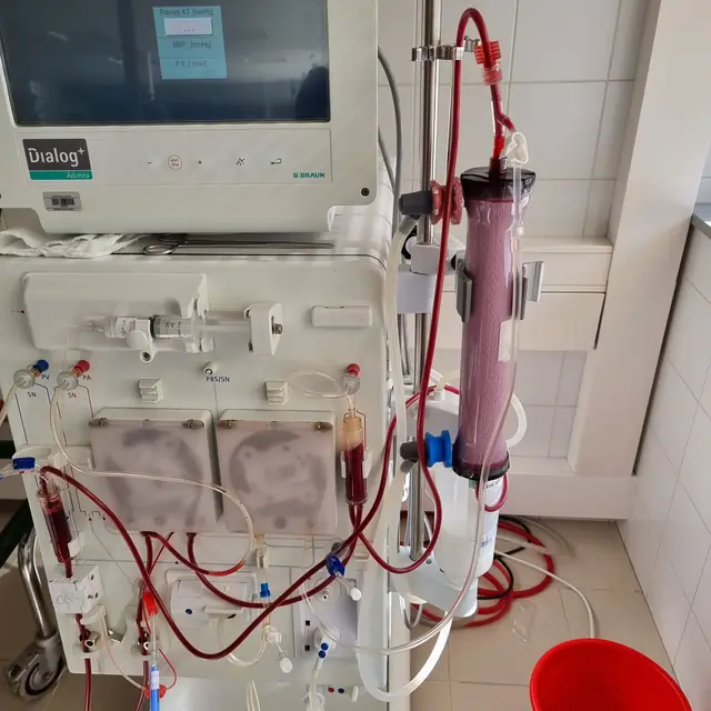 B. Braun Dialog+ hemodialysis machine set up for HDF online