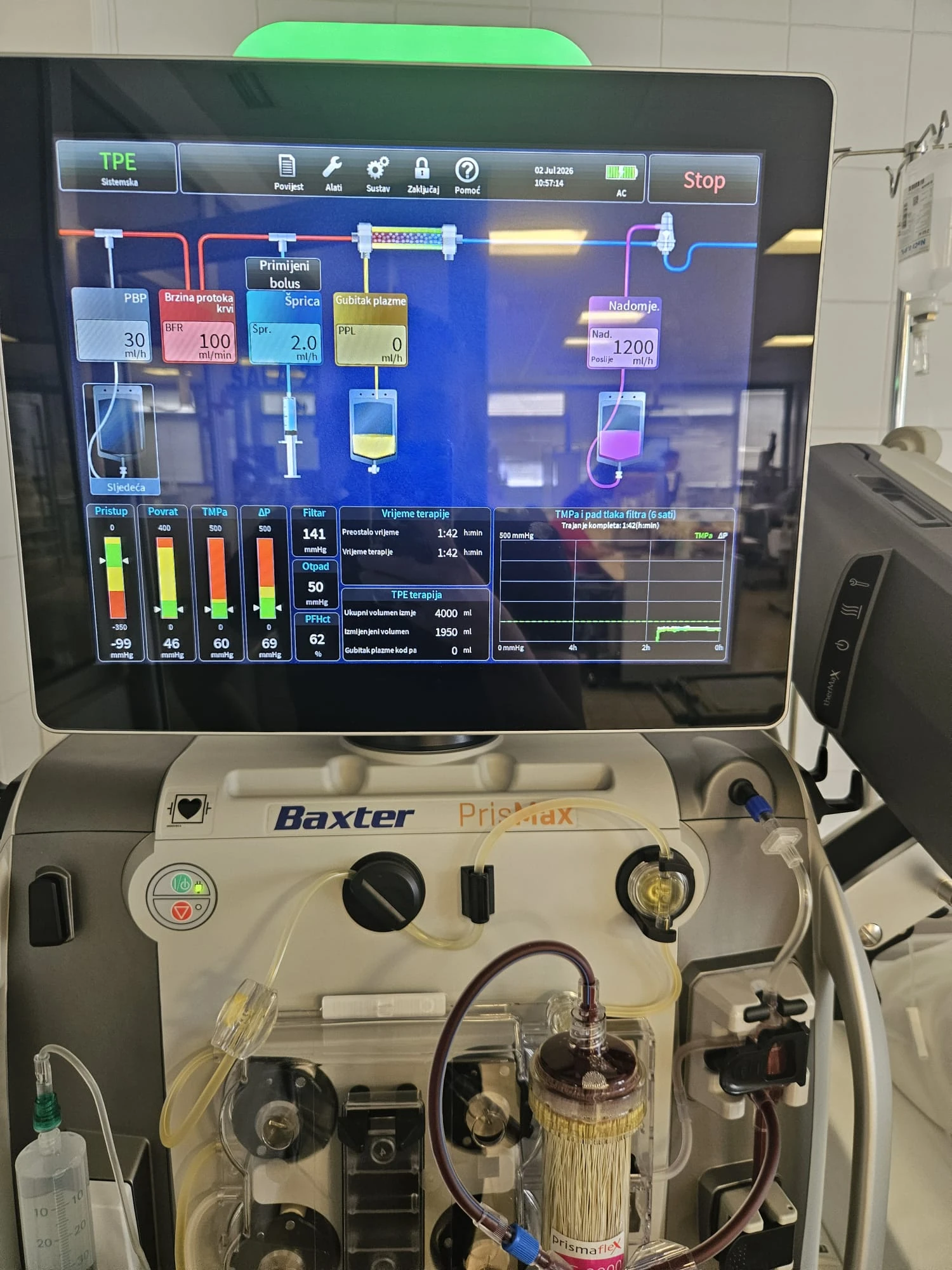 PrisMax machine screen during therapeutic plasma exchange, showing pressures and treatment parameters